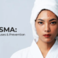 Melasma Treatment, Melasma Causes, and Melasma Prevention