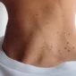 How do dermatologists remove skin tags from eyelids