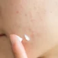 Should i see a dermatologist for acne
