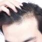 do dermatologists treat hair loss