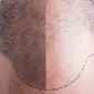 major causes and treatment of hair prp