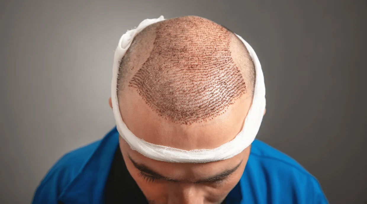 Hair Transplant 1
