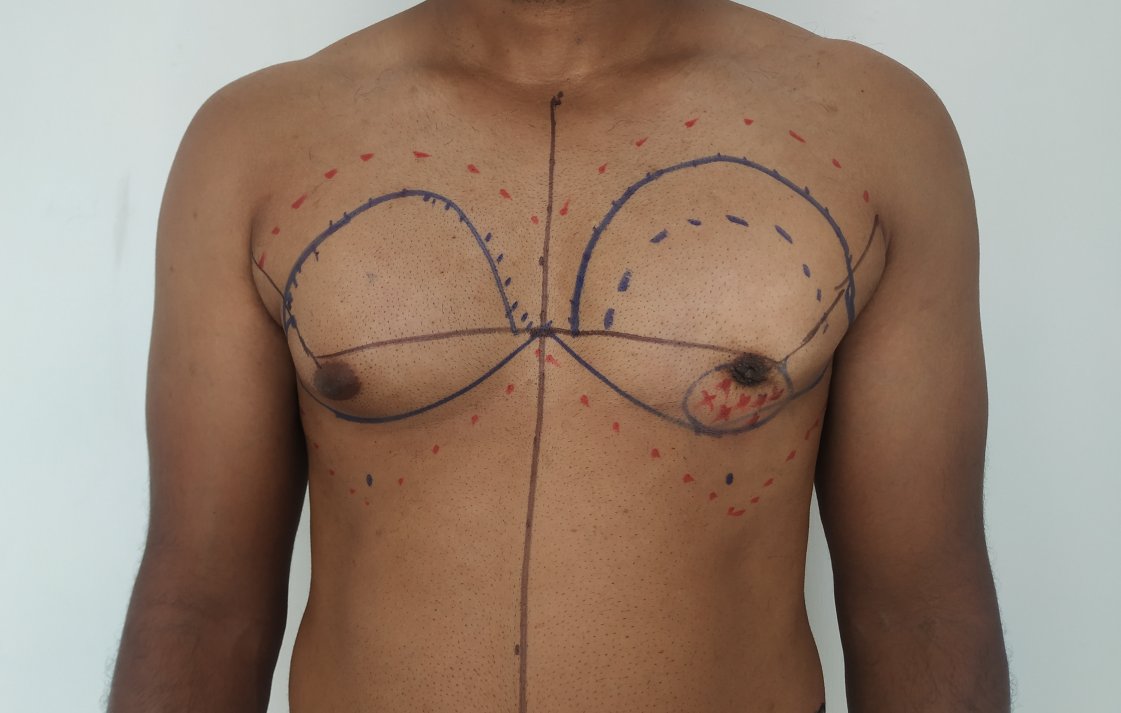 gynecomastia secondary_orig