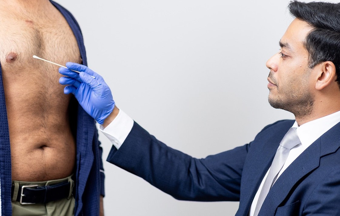gynecomastia
