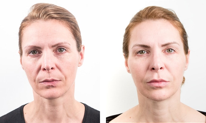 Non Surgical Face Lift Fillers