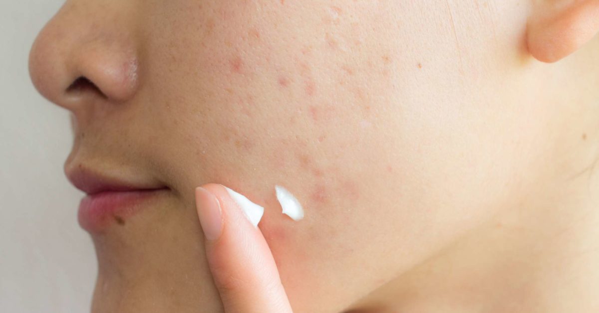 Open Pores Treatment