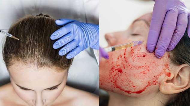 PRP Treatment 1