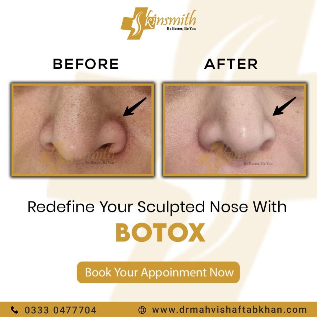 BOTOX2