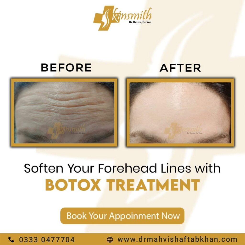 BOTOX4