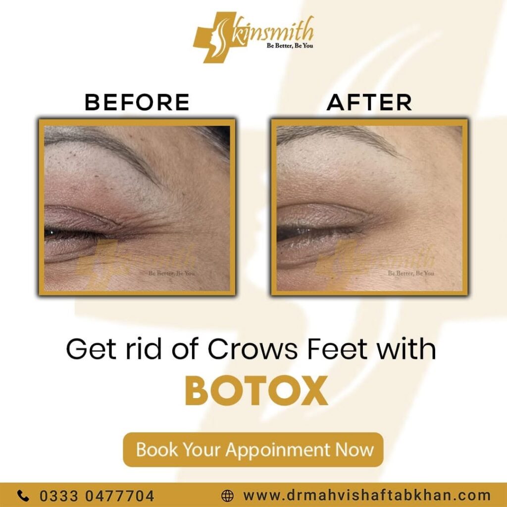 BOTOX6