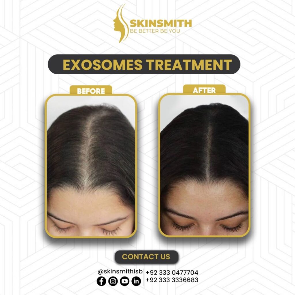 Exosomes