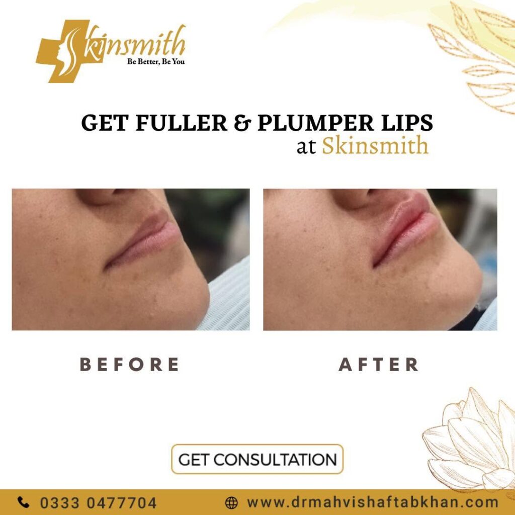 Fillers3