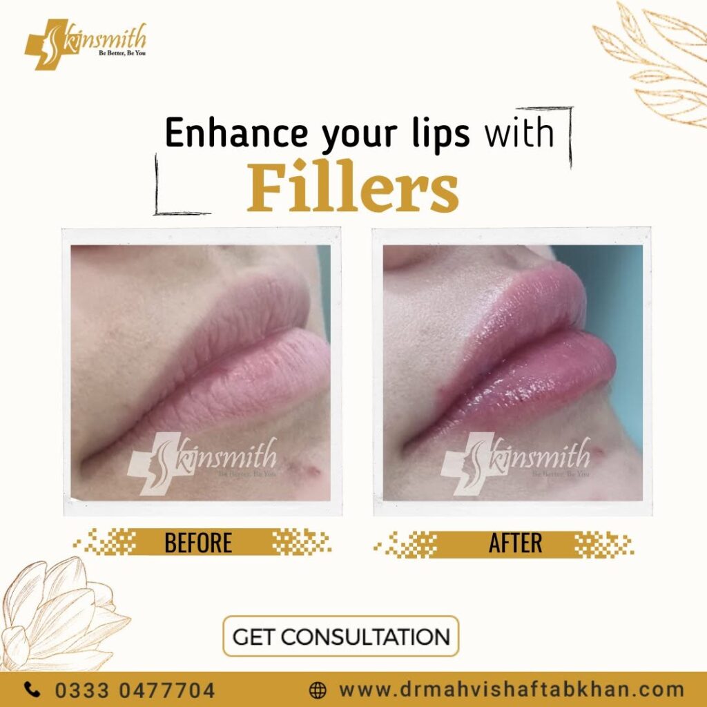 Fillers4