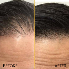Hair Transplant1
