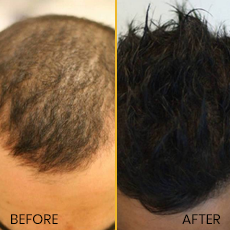 Hair Transplant2