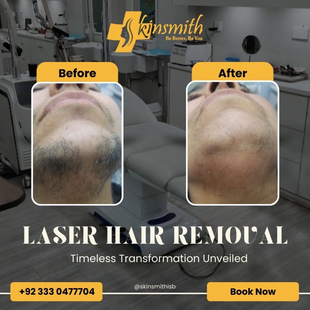 Laser Hair Removal1