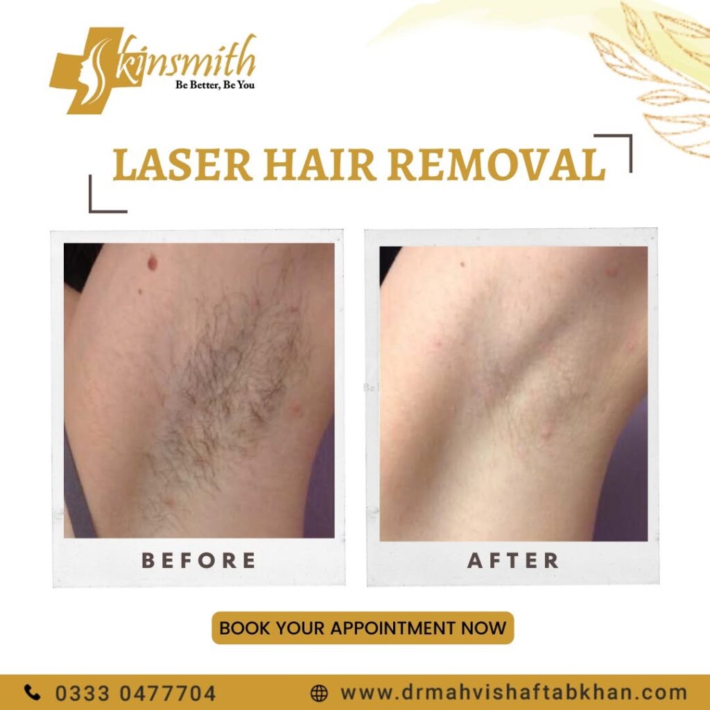 Laser Hair Removal3