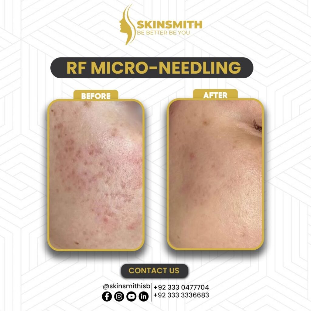 Microneedling1